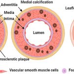 Гиперкальцемия и кальцификация сосудов: причины и последствия