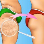 Что такое "Целлюлит" ?