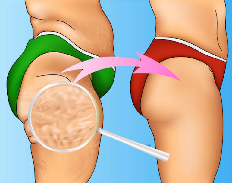 Что такое “Целлюлит” ?
